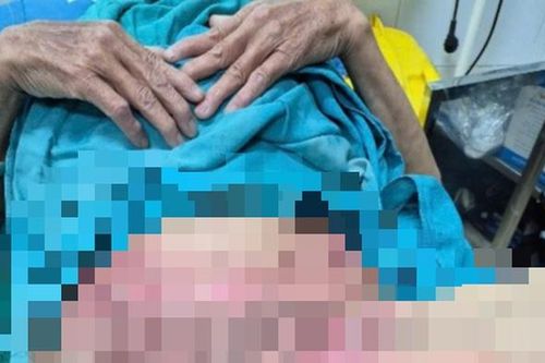 Tự điều trị viêm 'vùng kín', người phụ nữ ở Lạng Sơn bỏng nặng, lở loét toàn bộ vùng sinh dục