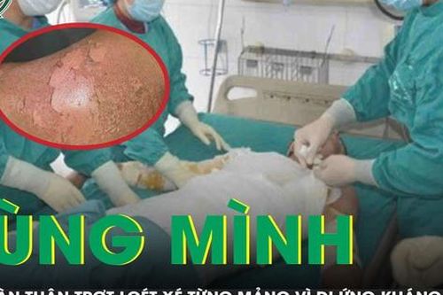 Rùng mình: Người phụ nữ bị lột da như phỏng nặng vì dị ứng kháng sinh