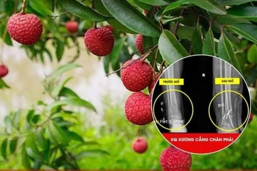 Gãy 5 xương sườn, mất vận động chân do trèo cây hái vải