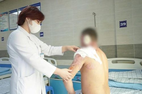 Người đàn ông nhập viện cấp cứu vì bỏng nặng do xăng bén lửa