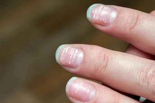 5 dấu hiệu trên móng tay cảnh báo bạn đang thiếu vitamin nghiêm trọng