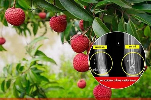 Người đàn ông 51 tuổi ở Phú Thọ nhập viện gấp sau khi trèo cây hái vải
