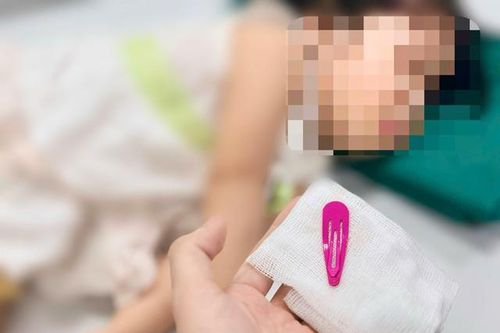 Thót tim gắp chiếc kẹp tóc sắc nhọn dài 5 cm trong dạ dày bé gái