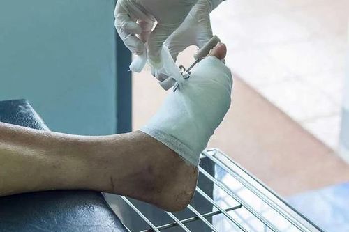 Một sai lầm nhỏ khiến cụ ông nhập viện với nguy cơ cắt cụt chân