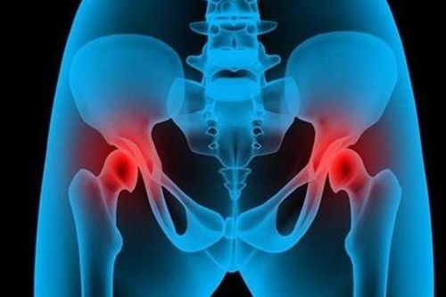 Triệu chứng sớm của thoái hóa khớp háng