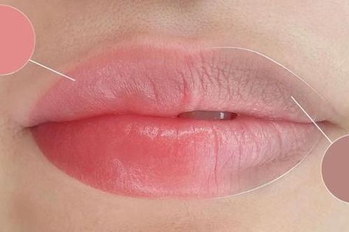Nguyên nhân khiến môi thâm và cách khắc phục hiệu quả