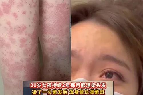 Nhuộm tóc liên tục suốt hai năm, cô gái ở Trung Quốc phải cạo đầu vì suy thận