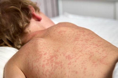 Cảnh giác với dấu hiệu bệnh sởi ở trẻ