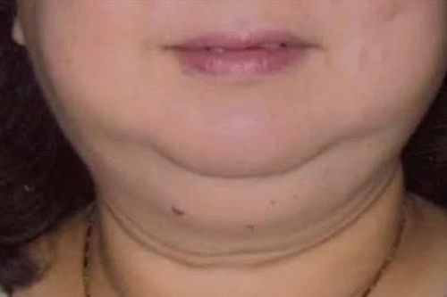 Dùng corticoid kéo dài, nguy cơ gây ra bệnh cushing