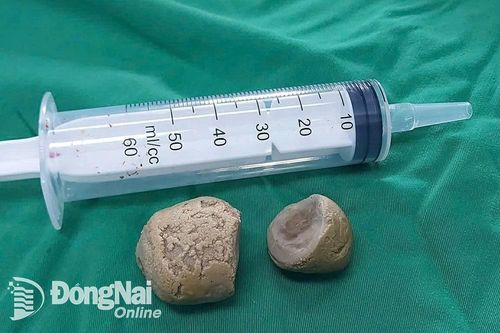 Mổ sỏi lớn cho bệnh nhân bị dị tật bẩm sinh đường tiết niệu
