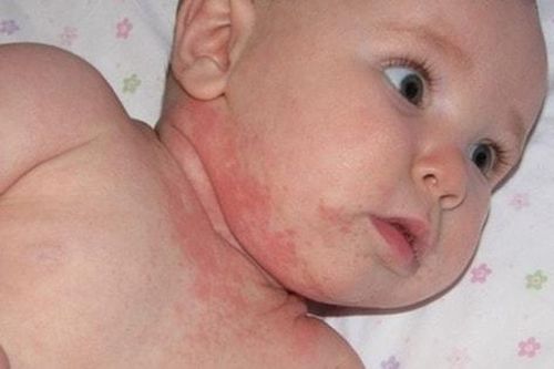 Bác sĩ tại nhà: Dị ứng đạm sữa bò ở trẻ em