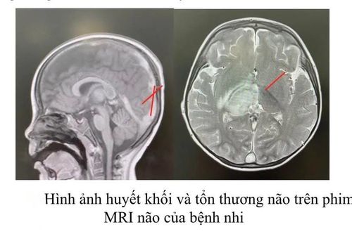 Bé trai hôn mê do huyết khối tĩnh mạch nội sọ