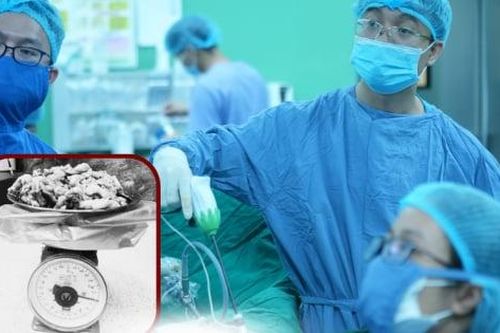10 năm mang khối u xơ tử cung nặng hơn 1,4kg