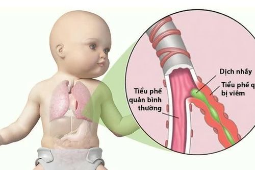 Bé uống kháng sinh chữa viêm phế quản liên tục có ảnh hưởng gì không?
