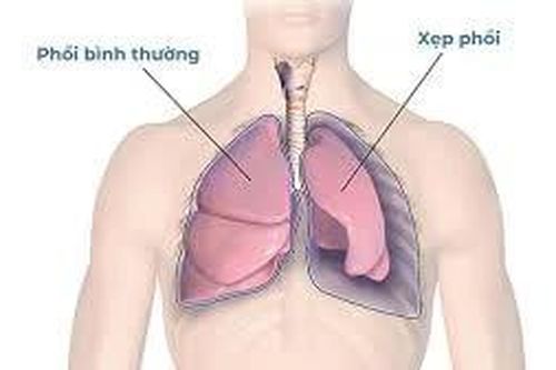Bị xẹp phổi có hồi phục được không?