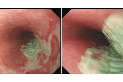 Người đàn ông 35 tuổi bị loét thực quản vì mắc sai lầm này khi uống thuốc
