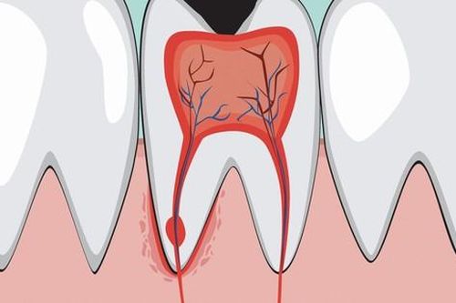 Viêm tủy răng ở trẻ có biểu hiện gì, hệ lụy ra sao?