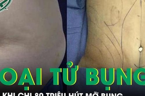 Chi 80 triệu làm đẹp, người phụ nữ hoại tử bụng sau khi hút mỡ