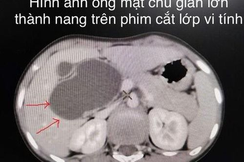 Bệnh viện Trẻ em Hải Phòng nội soi cắt nang ống mật chủ lớn cho bệnh nhi 10 tuổi