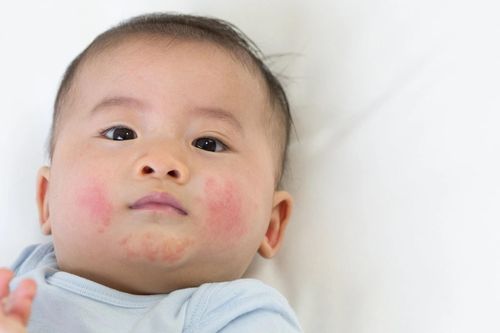 Dấu hiệu cảnh báo trẻ bị viêm da cơ địa
