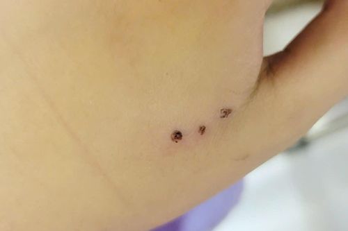 Bé 10 tuổi nhập viện vì bị chuột cắn