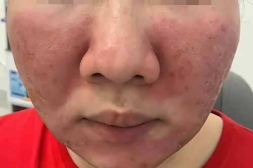 Nữ sinh bị hủy hoại gương mặt vì mua kem chống nắng trên mạng với giá 95.000 đồng