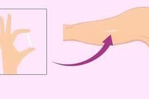 Que tránh thai ẩn sâu dưới cơ tay có ảnh hưởng đến khả năng mang thai không?