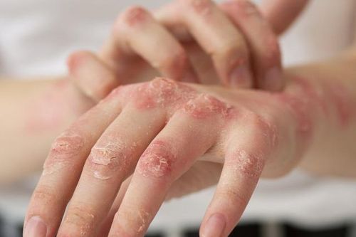 5 bệnh về da nguy hiểm thường gặp sau bão, lũ lụt