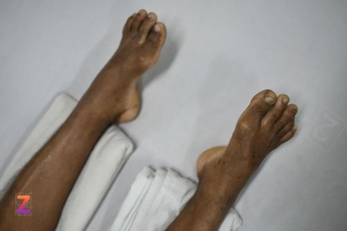 Căn bệnh từ vết trầy xước nhỏ có thể cướp đi mạng sống