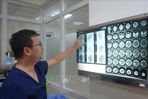 Cứu sống bệnh nhi xuất huyết não ở trẻ do dị dạng mạch máu