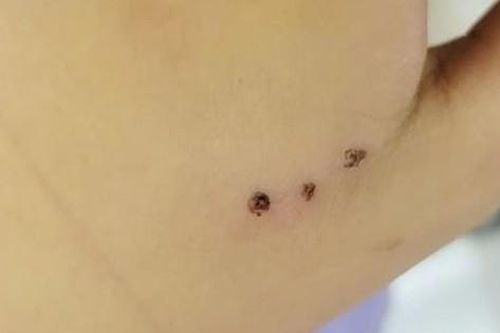 Bé 10 tuổi nhập viện sau khi bị chuột cắn
