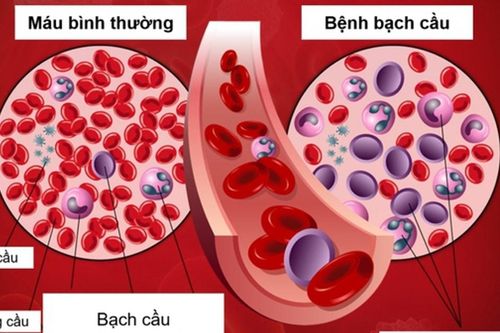Hiểu đúng về ung thư máu