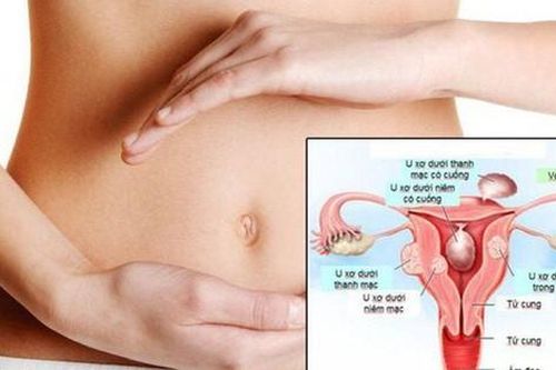 Người phụ nữ 48 tuổi ở Phú Thọ phát hiện u xơ tử cung nặng hơn 1,5kg từ dấu hiệu nhiều chị em Việt bỏ qua