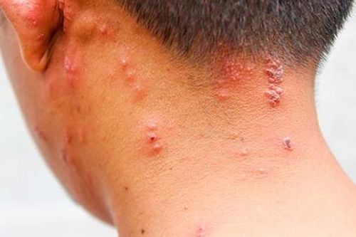 Cách chăm sóc bệnh nhân mắc zona thần kinh mau khỏi