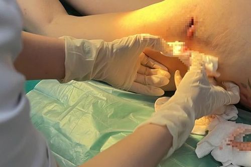 Chi gần 100 triệu nâng mông, người phụ nữ nhận 'trái đắng' với ổ viêm mủ gây đau đớn
