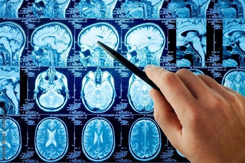 Yếu tố di truyền khiến cả làng mắc bệnh Alzheimer