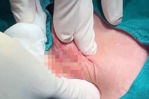 Bỏ gần trăm triệu nâng mông, 2 phụ nữ nhận 'kết đắng'