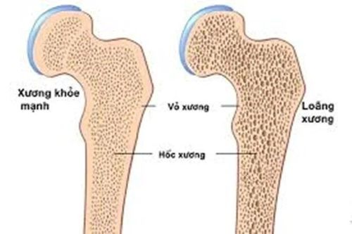 Nguyên nhân khiến nhiều người trẻ mắc bệnh loãng xương