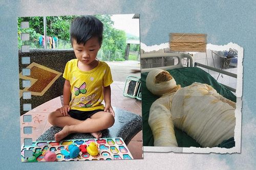 Bác sĩ kêu gọi giúp người đàn ông bị bỏng nặng không có bảo hiểm nuôi 5 con nhỏ
