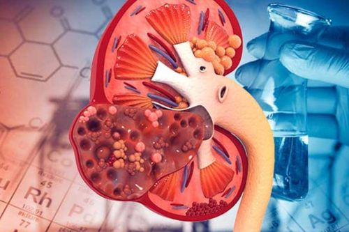 Dấu hiệu nhận biết ung thư thận