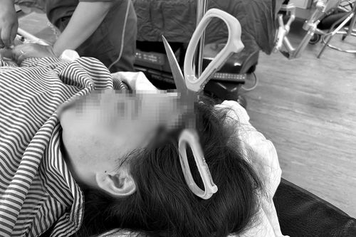 Cứu cô gái bị lưỡi kéo đâm xuyên sọ