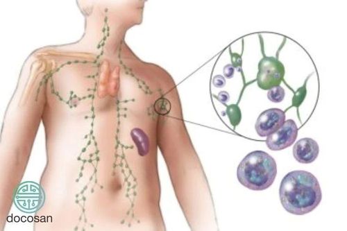Nhận diện dấu hiệu mắc bệnh u lympho