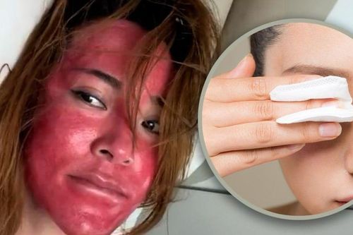 Không tẩy trang suốt 22 năm, người phụ nữ nhận hậu quả đau đớn