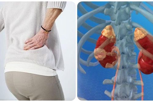 Triệu chứng ung thư thận giai đoạn cuối