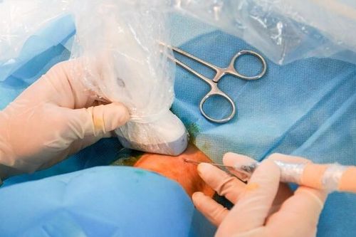 Đốt sóng cao tần điều trị u tuyến giáp lành tính không cần phẫu thuật