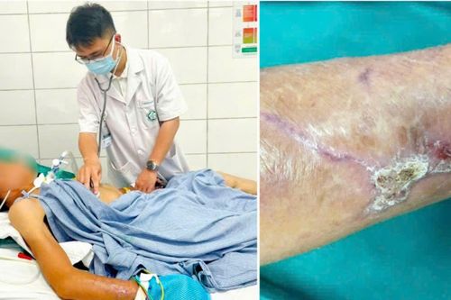 Suýt mất mạng vì chủ quan với vết thương ngoài da