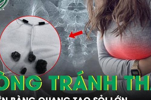 Tưởng viêm đơn thuần, hóa ra vòng tránh thai xuyên thủng bàng quang tạo sỏi