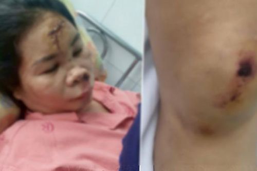 Xác minh thông tin vụ cướp giật khiến người phụ nữ bị chấn thương sọ não
