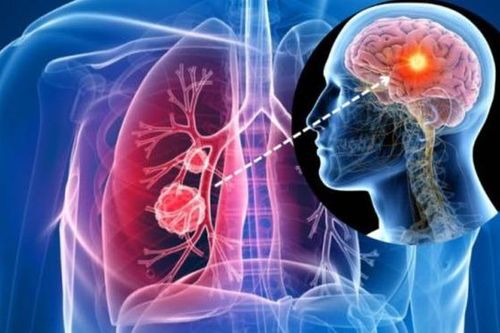 Vì sao ung thư phổi thường di căn lên não?