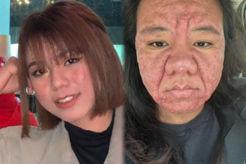 Sốc với gương mặt biến đổi khi mang thai của bà mẹ Malaysia